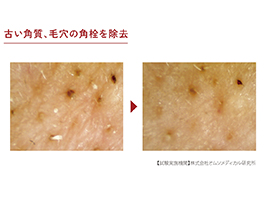 1_3-16 イメージ:古い角質・毛穴の角栓を除去