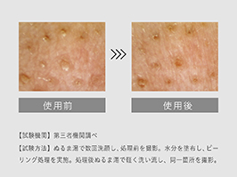 1_4-14 イメージ:古い角質、角栓を除去